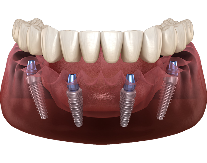 Протезирование <br> All-ON-4 на 4 имплантах OSSTEM